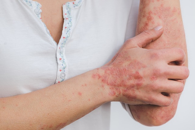 Ilustrasi penyakit kulit scabies. (Pixabay)