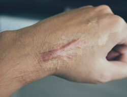 Keloid. (Pixabay)